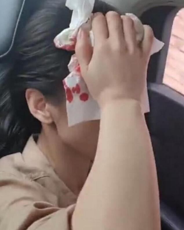 黄圣依拍戏受伤砸伤头部